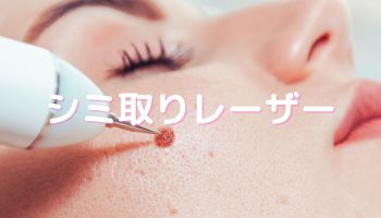 シミ取りレーザー